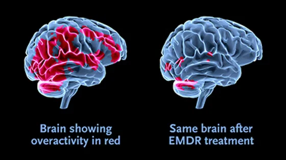 EMDR-Brainwebp Pic - Diagram of FMRI-scan showing EMDR brain
