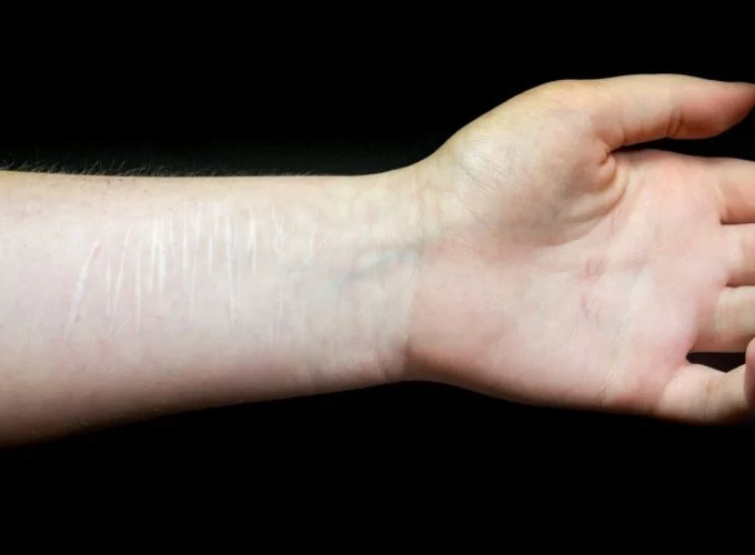 self-harm-680×500-1webp Image of arm with razor cuts - depicting self-harm